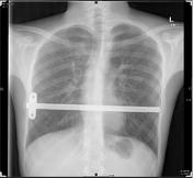 Tag: pectus excavatum | Radiopaedia.org