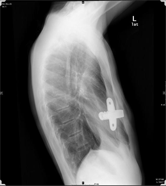 Chest radiography after the Nuss procedure. Four types of bar