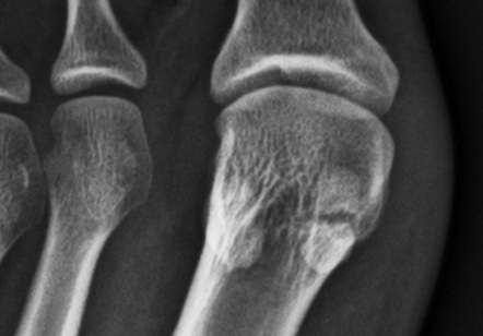 Hallux Sesamoid Fracture Radiology Reference Article Radiopaedia Org