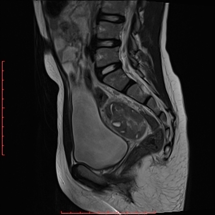 Ovarian torsion | Radiology Case | Radiopaedia.org