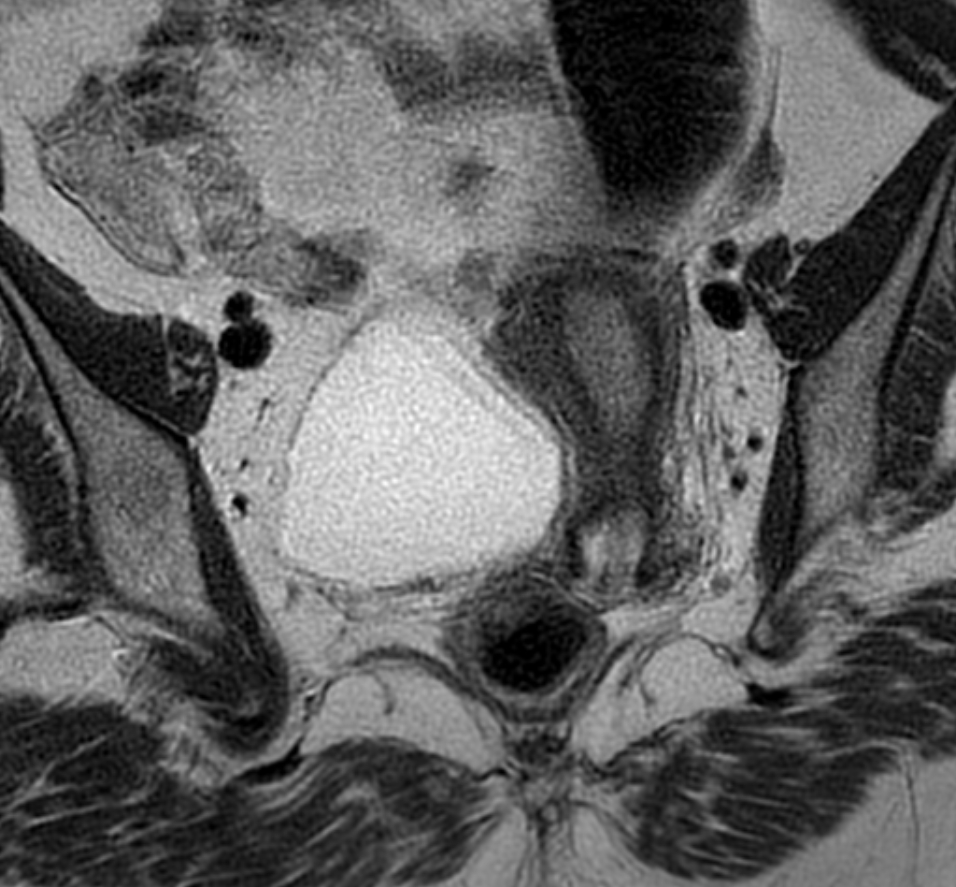 Endometrial polyp | Image | Radiopaedia.org