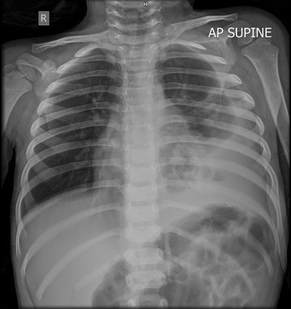 Pleural effusion | Radiology Case | Radiopaedia.org