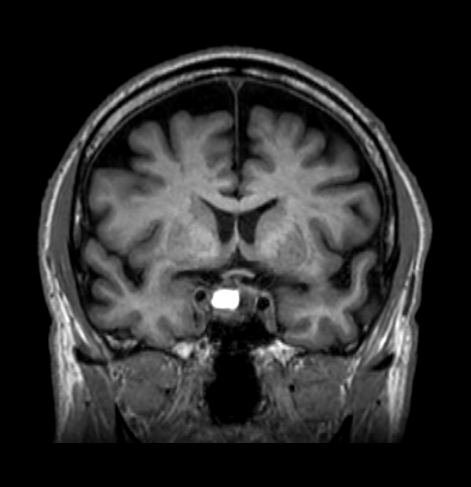 Pituitary apoplexy with intraventricular hemorrhage | Image ...