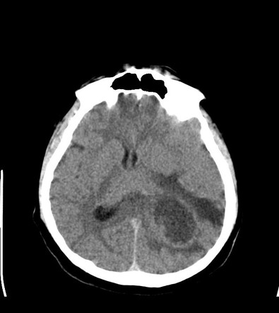 Cystic glioblastoma | Radiology Case | Radiopaedia.org