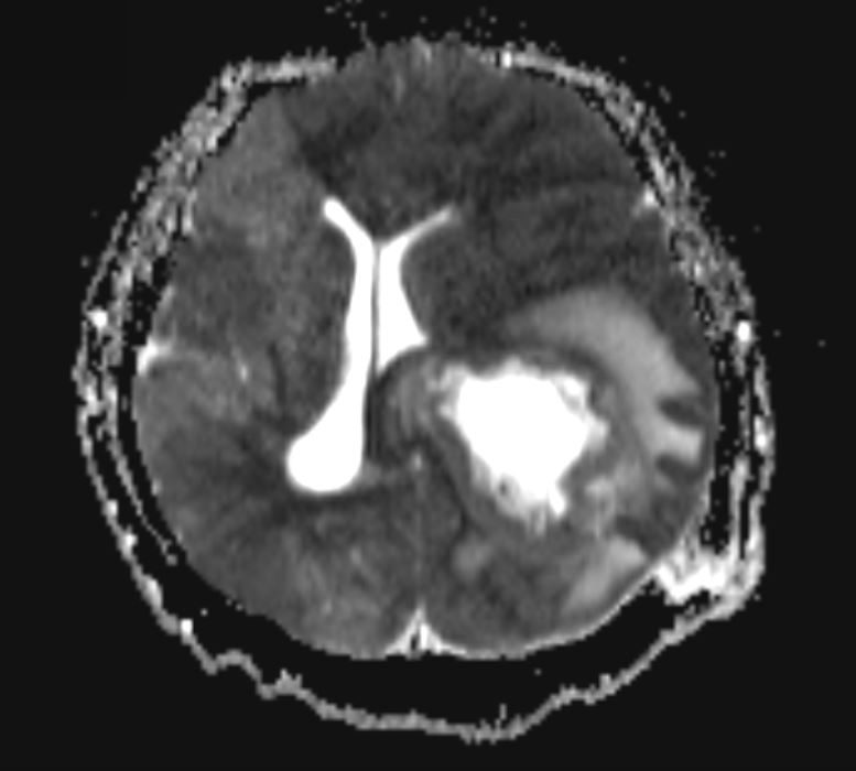 Cystic glioblastoma | Image | Radiopaedia.org