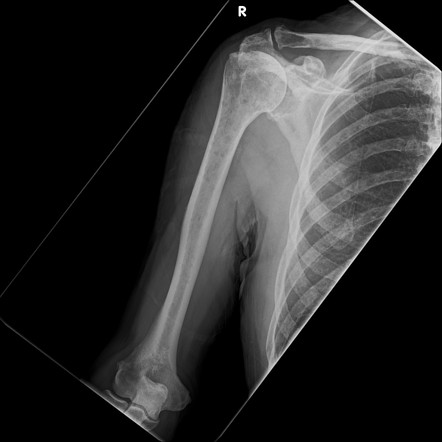 Multiple myeloma | Radiology Case | Radiopaedia.org