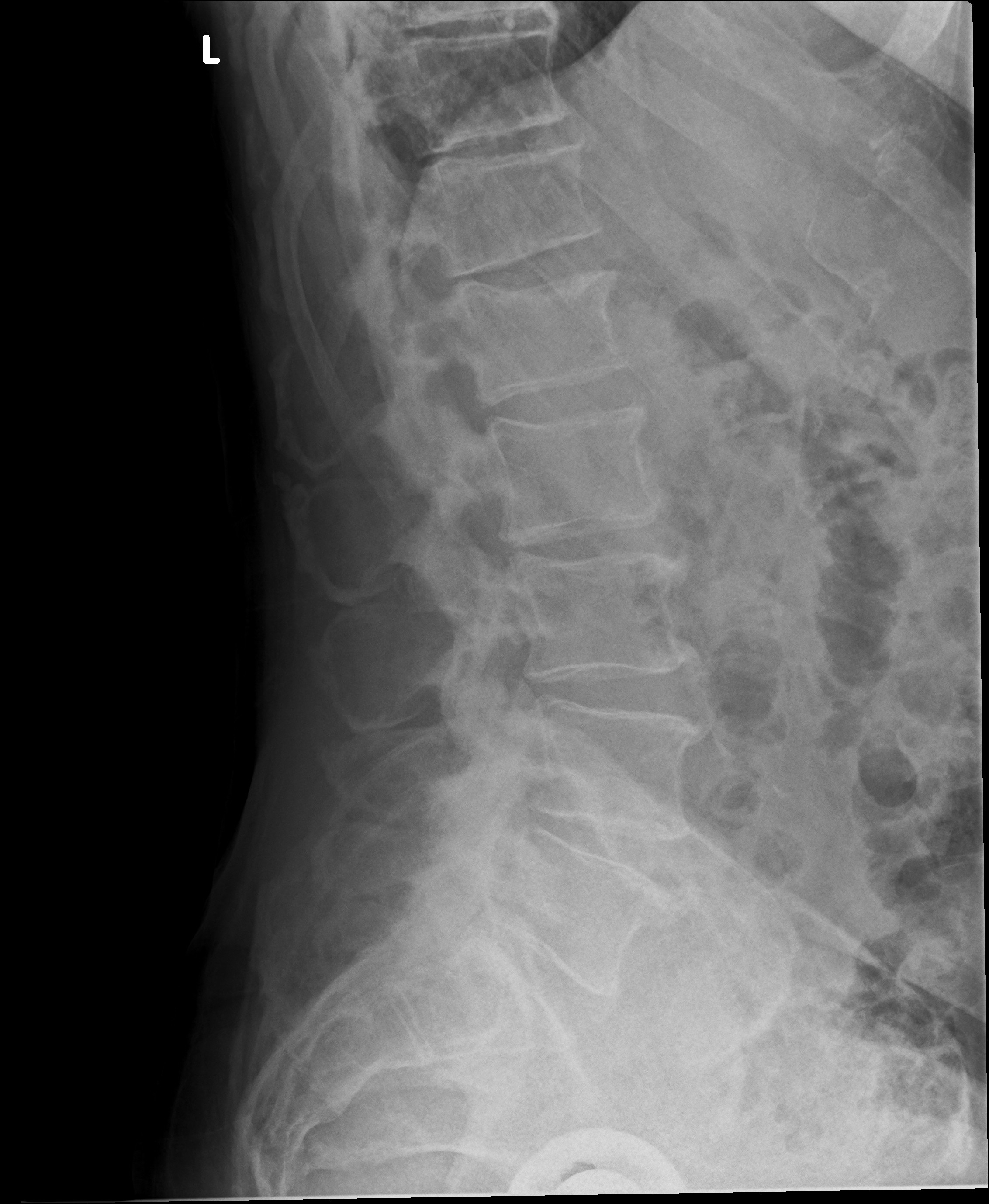 Multiple myeloma | Image | Radiopaedia.org