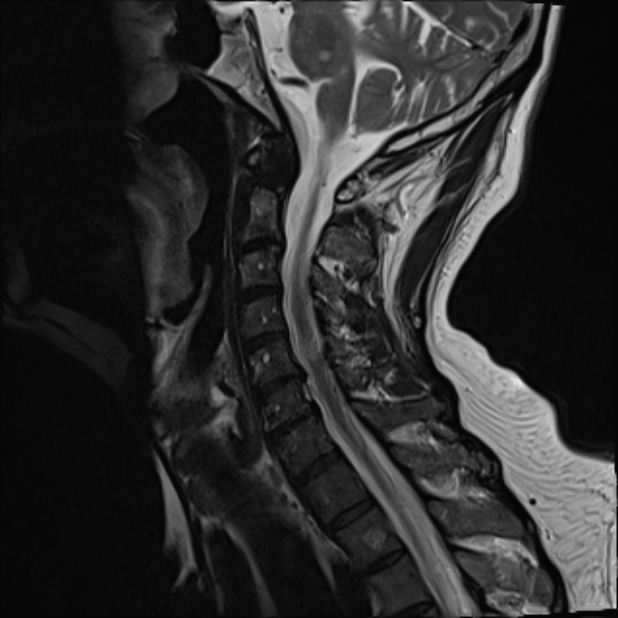 Retroclival hematoma | Image | Radiopaedia.org