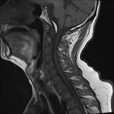 Retroclival hematoma | Radiology Case | Radiopaedia.org