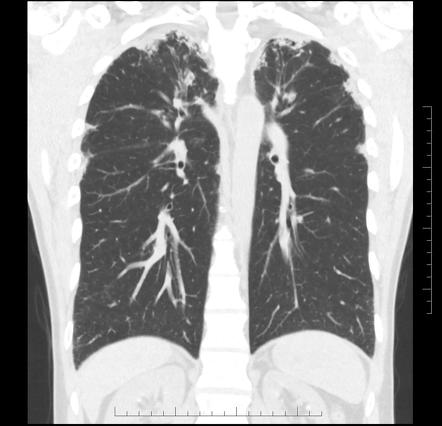 Pleuroparenchymal fibroelastosis | Radiology Reference Article ...