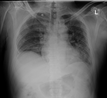 Stanford Type B Aortic Dissection 