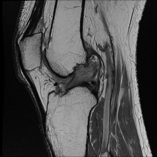 Anterior cruciate ligament mucoid degeneration | Radiology Reference ...