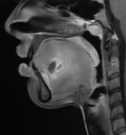 Soft tissue abscess | Radiology Reference Article | Radiopaedia.org