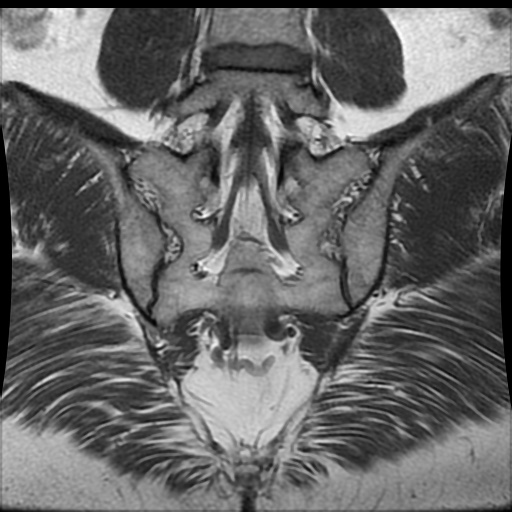 Normal sacroiliac joints (MRI) | Image | Radiopaedia.org