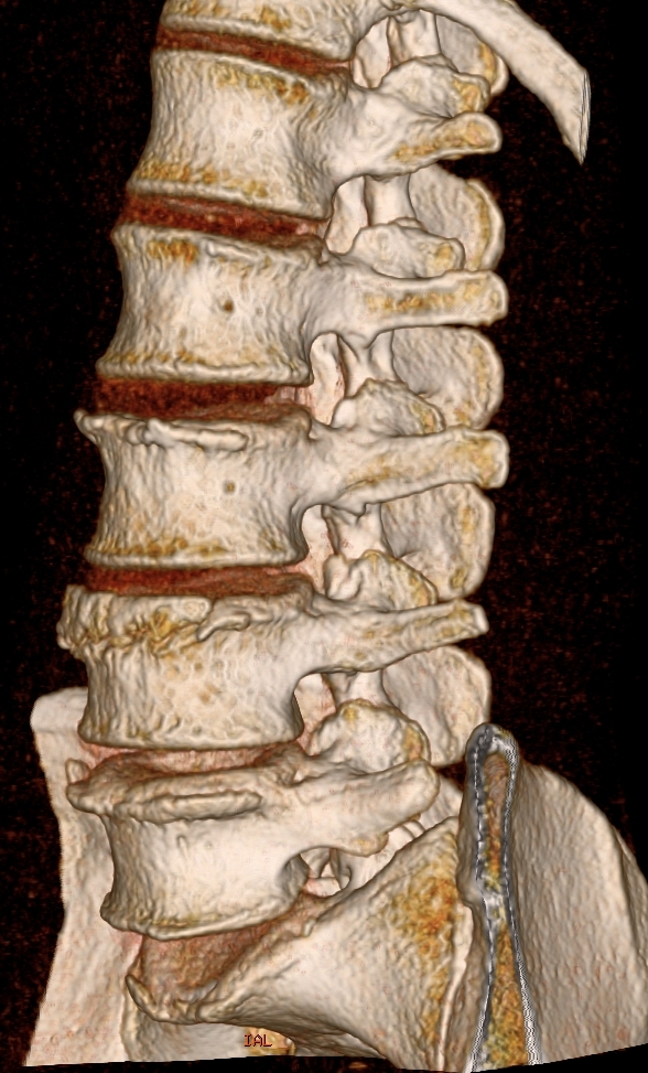 Остеофиты позвоночника. Остеофиты l3-l5. L1-l5 краевые остеофиты. Лимбус Вертебра рентген. Краевые остеофиты l3-l4.