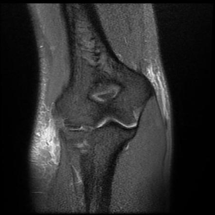 Triceps brachii tendon full-thickness tear | Radiology Case ...