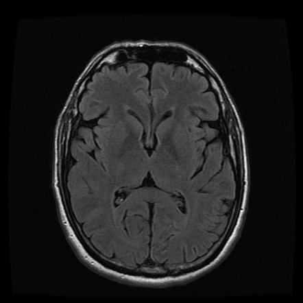 Internal carotid artery dissection | Image | Radiopaedia.org