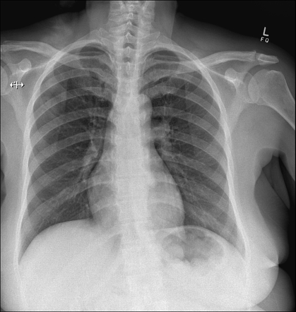 Cronkhite-canada Syndrome 