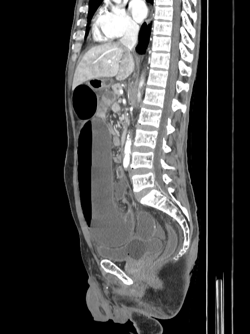 Sigmoid volvulus | Image | Radiopaedia.org