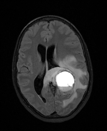 Hemorrhagic cystic glioblastoma | Image | Radiopaedia.org