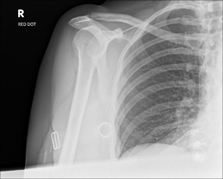 Medial aspect of clavicle fracture | Image | Radiopaedia.org