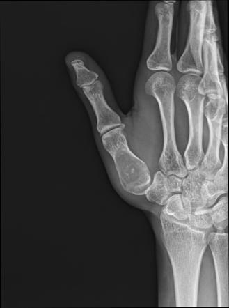 Enchondroma - first metacarpal | Radiology Case | Radiopaedia.org