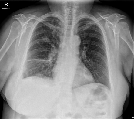 Parapneumonic effusion - loculated | Image | Radiopaedia.org