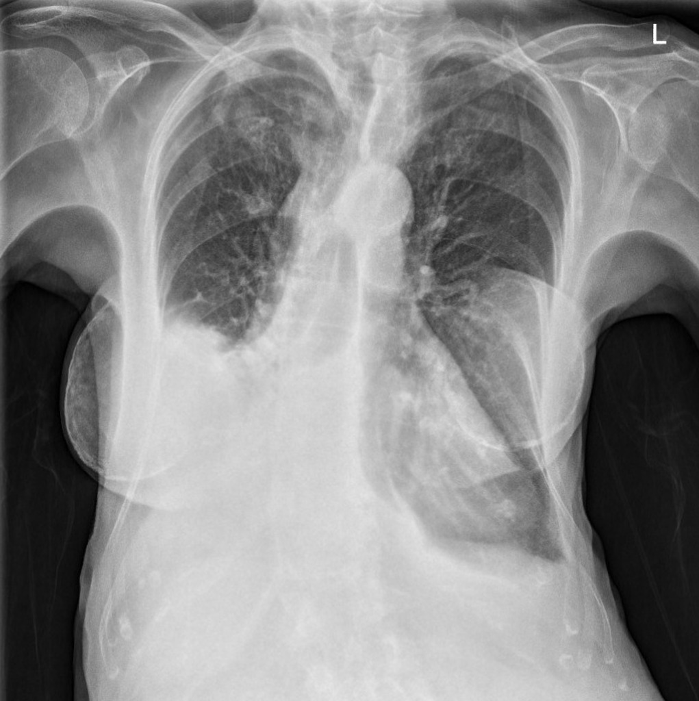 can-a-chest-ct-detect-lung-cancer