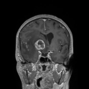 Basal ganglia metastasis Radiology Case Radiopaedia