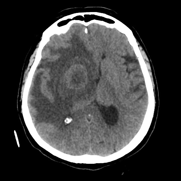 Basal ganglia metastasis Radiology Case Radiopaedia