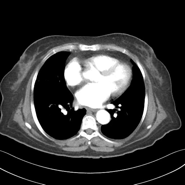 Basal ganglia metastasis Radiology Case Radiopaedia