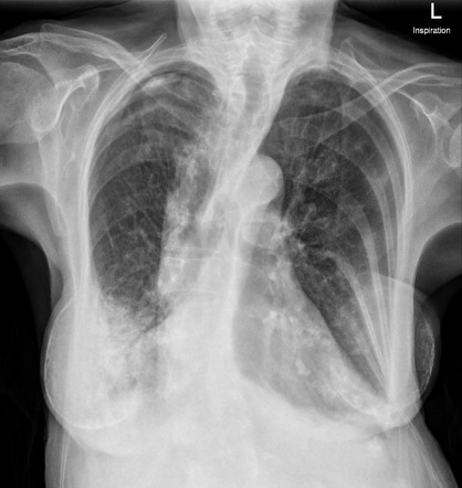 Transudative pleural effusion | Image | Radiopaedia.org