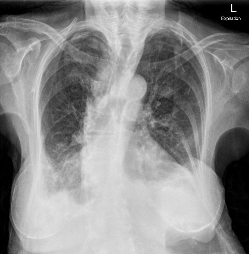 Transudative pleural effusion | Image | Radiopaedia.org