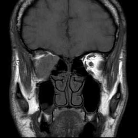 Optic pilocytic astrocytoma | Image | Radiopaedia.org