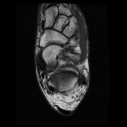 Calcaneum and distal tibia stress fractures (MRI) | Radiology Case ...