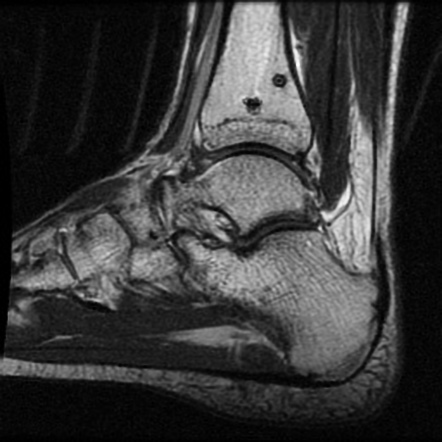 Calcaneum and distal tibia stress fractures (MRI) | Image | Radiopaedia.org