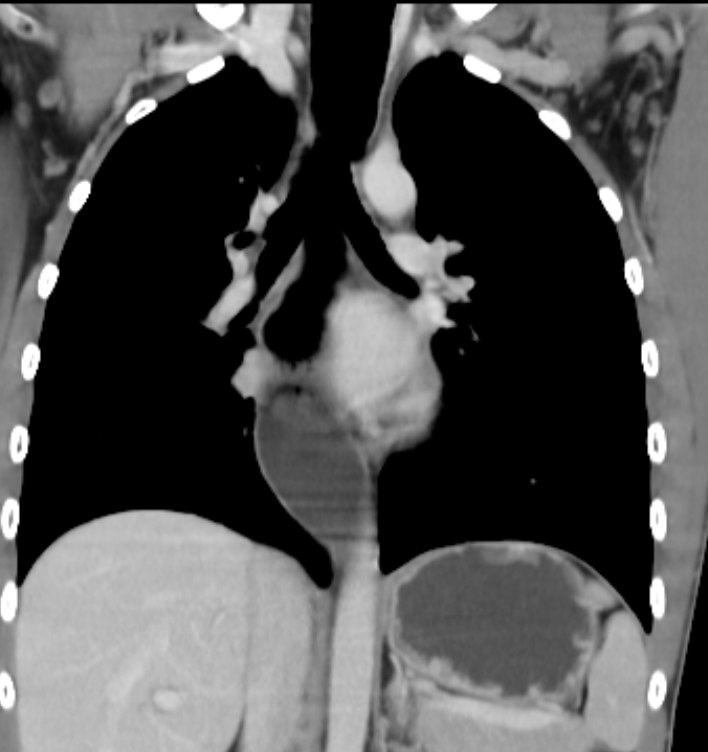 Achalasia (CT) | Image | Radiopaedia.org