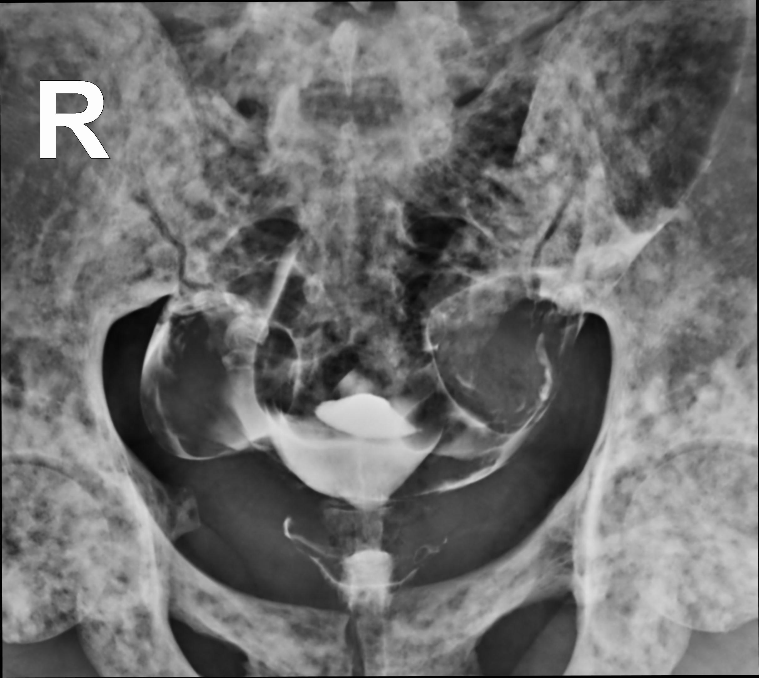 Osteopoikilosis | Image | Radiopaedia.org