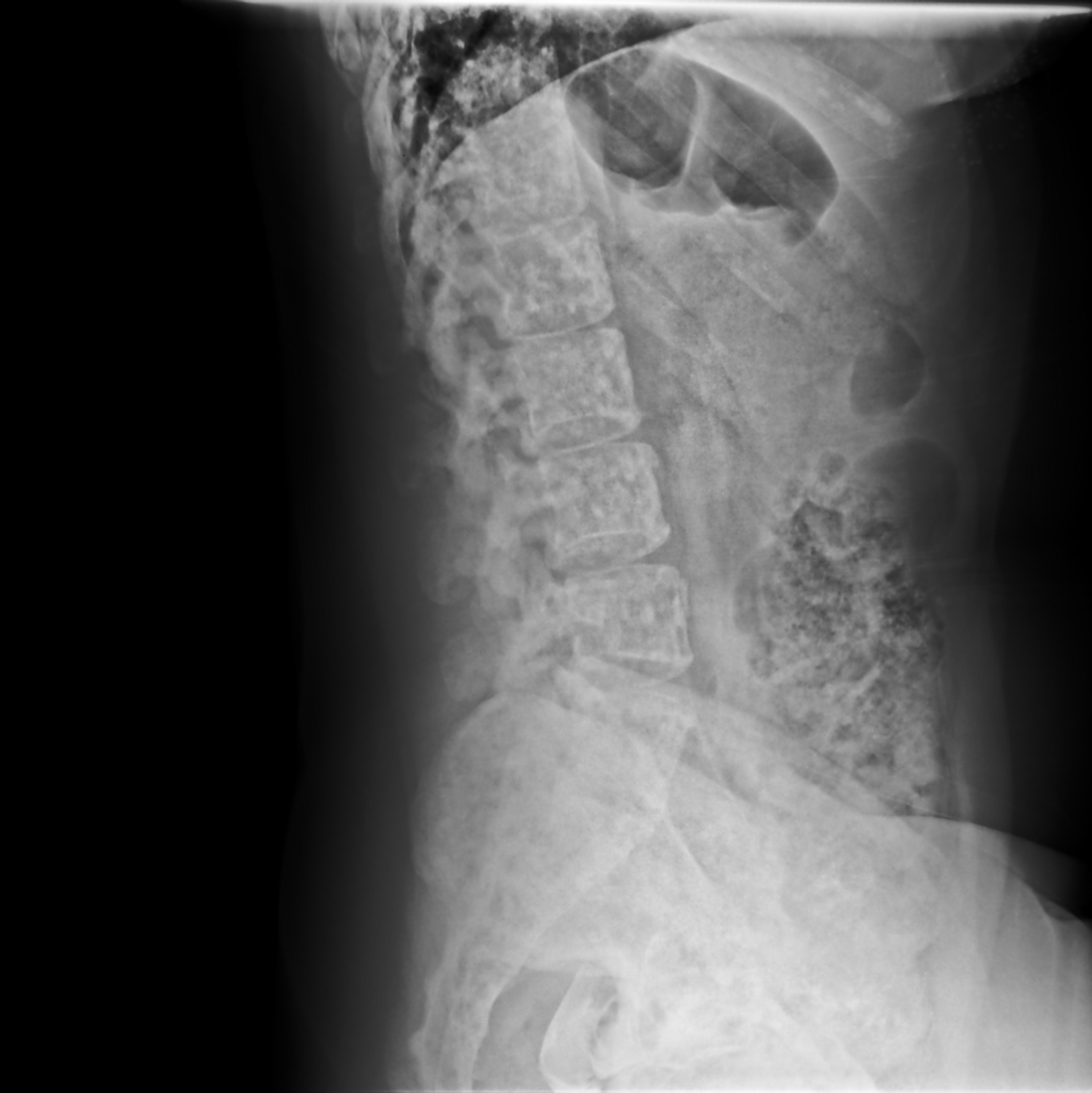 Osteopoikilosis | Image | Radiopaedia.org