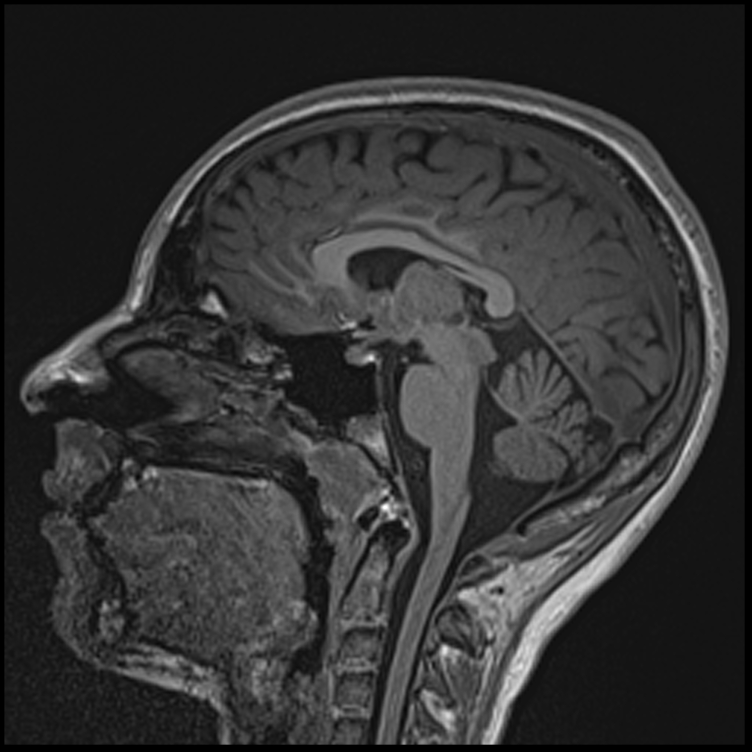 Rasmussen encephalitis | Image | Radiopaedia.org