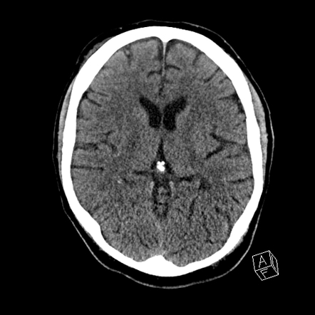 Cerebral abscess with ventriculitis | Radiology Case | Radiopaedia.org