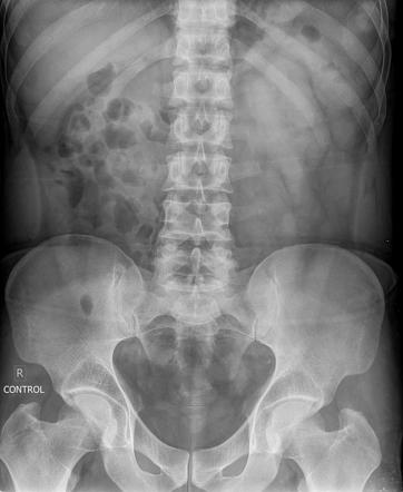 Intravenous Urography Radiology Reference Article Radiopaediaorg