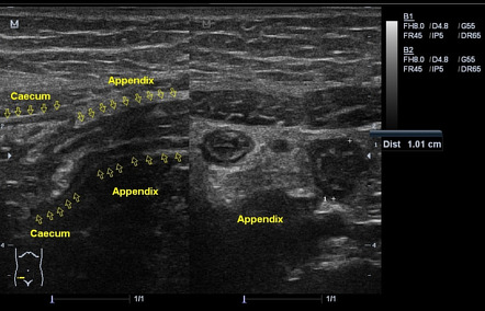 Acute Appendicitis | Radiology Case | Radiopaedia.org