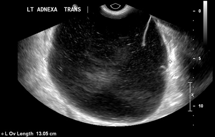 Ovarian Mucinous Cystadenoma | Radiology Reference Article ...