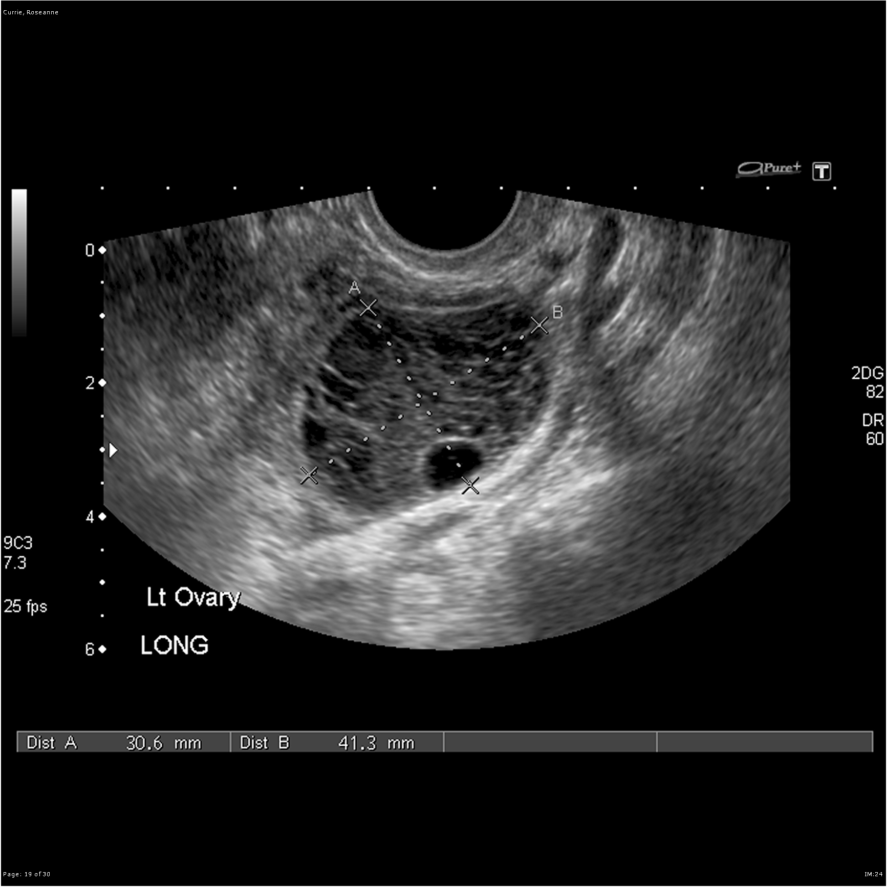 Exploring Sonograms For Ovarian Cysts Understanding The Role Of Obgyn Specialists Coach M Morris 6206