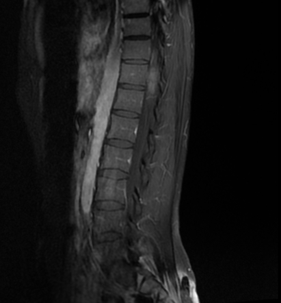 Myxopapillary ependymoma | Image | Radiopaedia.org