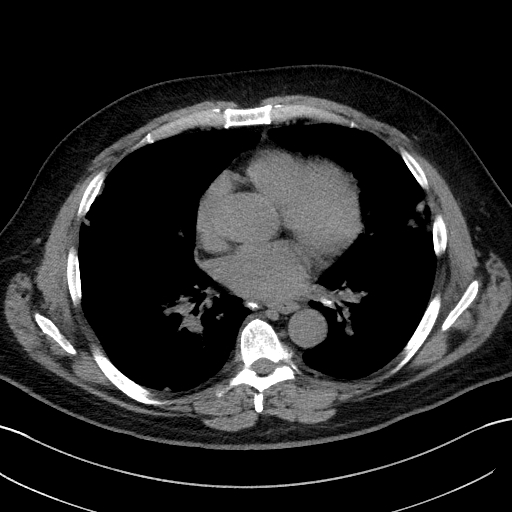 Pulmonary sarcoid | Image | Radiopaedia.org