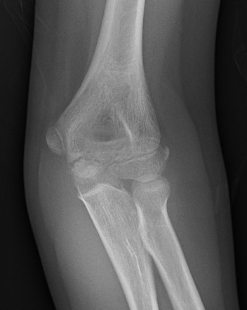 Olecranon fracture | Image | Radiopaedia.org