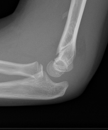 Supracondylar fracture | Image | Radiopaedia.org