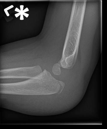 Olecranon fracture | Radiology Case | Radiopaedia.org